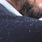 همه چیز درباره شوره سر در مردان + روشهای کنترل و درمان