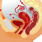دردهای اندومتریوز چه ویژگی هایی دارند؟