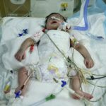 تولد نوزاد قمی با توده ۳۰ کیلوگرمی