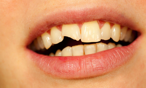۸ راه برای درمان ترک خوردگی و شکستگی دندان